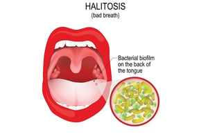 halitosis-biofilm